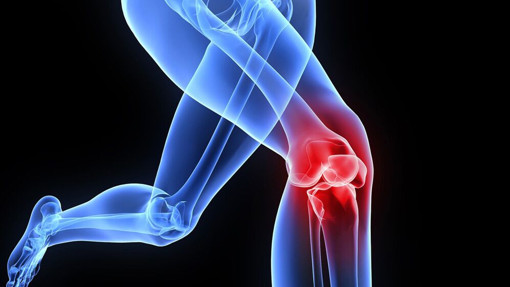 Kniebeschwerden aufgrund von Arthrose