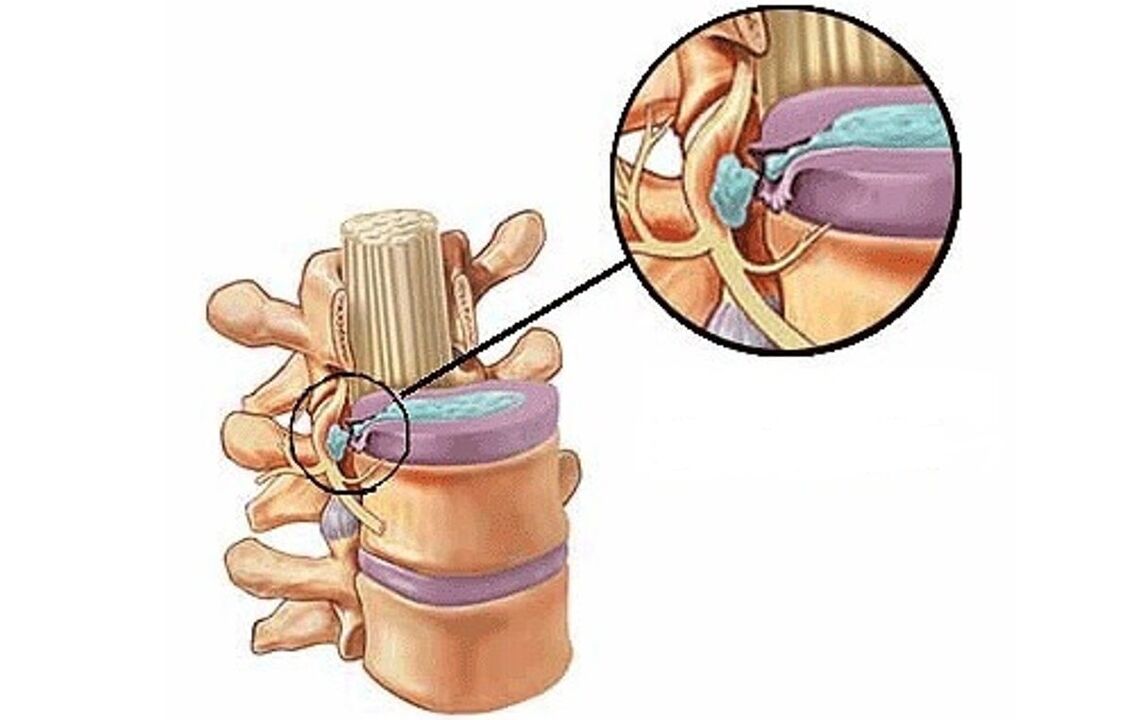 Zwischenwirbelhernie mit thorakaler Osteochondrose